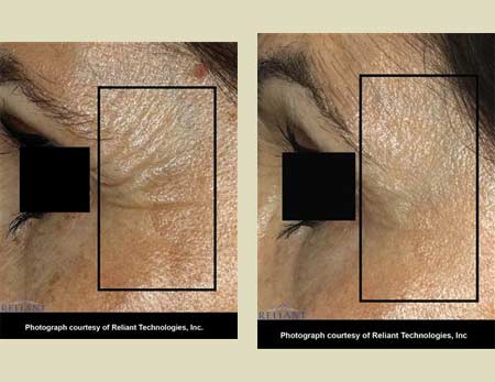Fraxel laser treatment before & after pictures