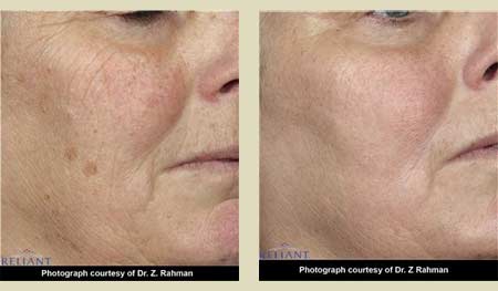 Fraxel laser treatment before & after pictures