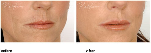 Restylane - Lips - Before & After Pictures