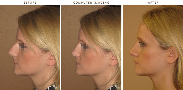 Plastic Surgery Computer Imaging