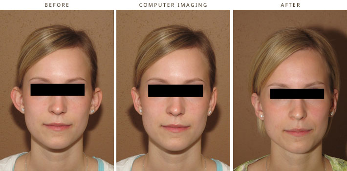 Plastic Surgery Computer Imaging