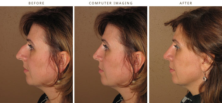 Plastic Surgery Computer Imaging