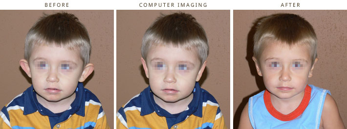 Plastic Surgery Computer Imaging