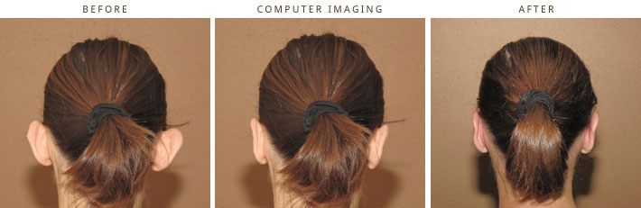 Plastic Surgery Computer Imaging