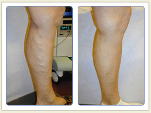 Varicose veins and broken vessels removal 01