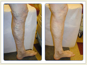 Varicose veins and broken vessels removal 04