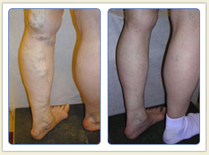 Varicose veins and broken vessels removal 06